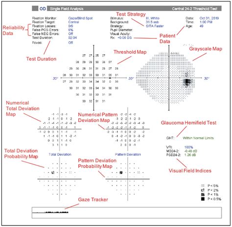 automated perimetry test results interpretation|Sharpen Your Visual Field Interpretation Skills .